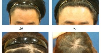زراعة الشعر من أجل علاج مشاكل الصلع